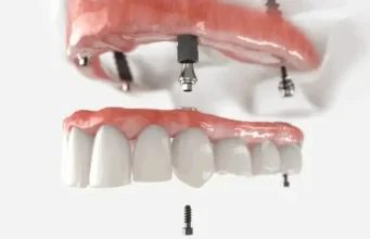 9 Things Nobody Tells You About Life With All-on-X, From Stubbs Dental and Other Utah Providers